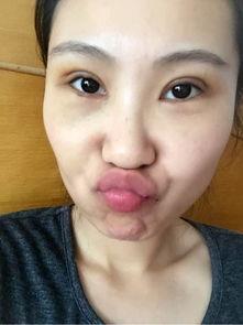 手术后吃的什么瓜,瓜类美食助力康复之旅